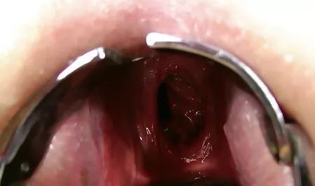Gái điếm tìm phim set dam nhat thấy sử dụng được bao cao su ở âm hộ của cô.